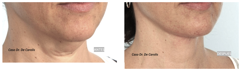 Corrección de un cuello joven con mini lifting mas hilos tensores.
