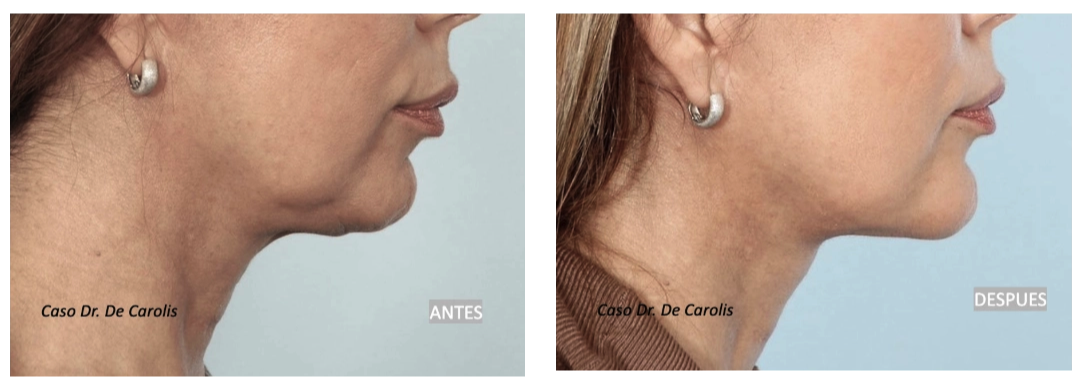 Definición del cuello y mentón con hilos tensores permanentes por el Dr. De Carolis. Vista perfil