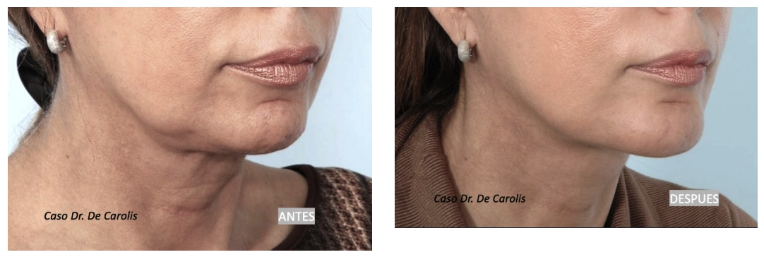 Definición del cuello y mentón con hilos tensores permanentes por el Dr. De Carolis.