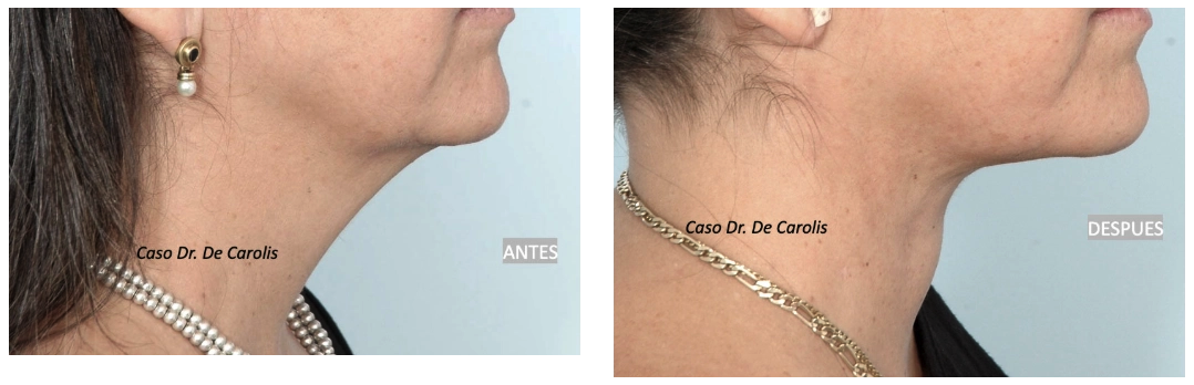 Lifting de cuello con hilos tensores permanentes y liposucción por el Dr. De Carolis: transformación armónica y natural.