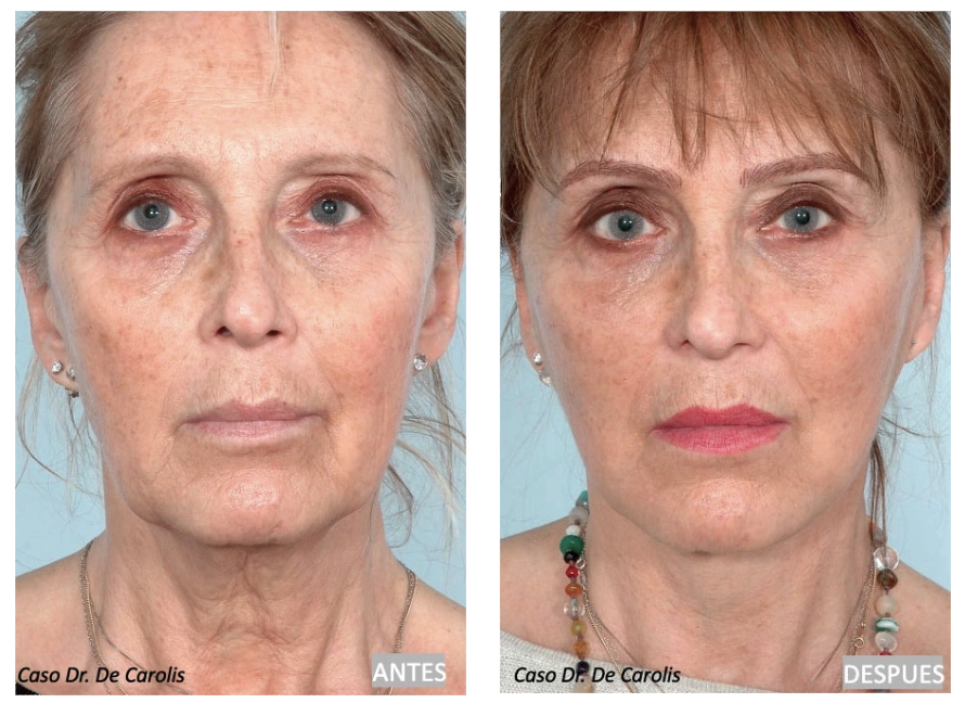 Lifting facial total con hilos tensores permanentes por el Dr. De Carolis: rejuvenecimiento integral de rostro y cuello.