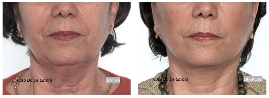 Lifting sin cicatrices con hilos tensores permanentes por el Dr. De Carolis: recuperación del contorno facial.
