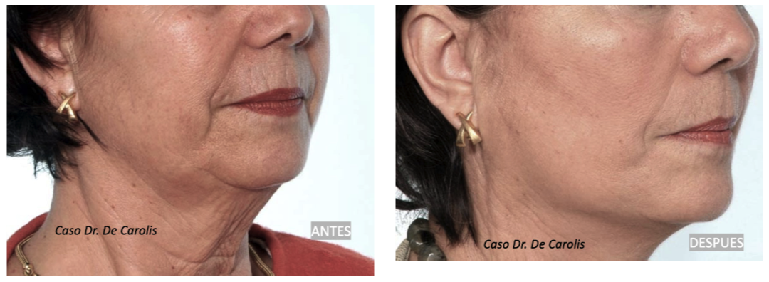 Lifting sin cicatrices con hilos tensores permanentes por el Dr. De Carolis: vista semiperfil.