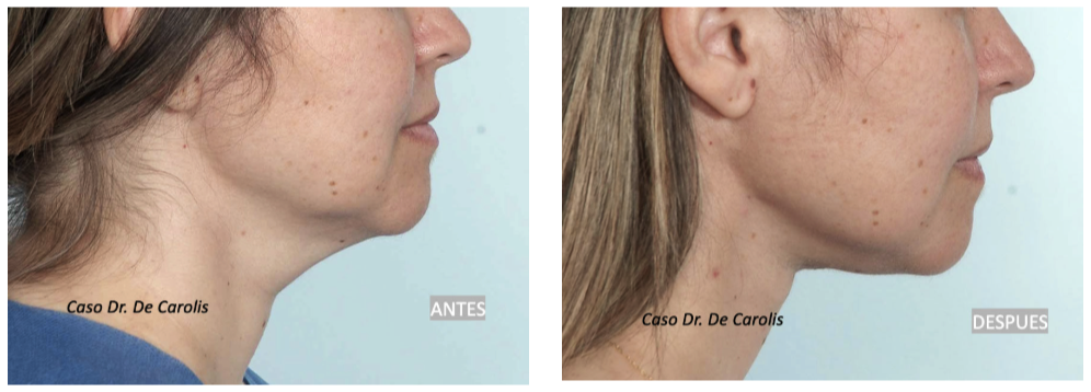 Mejora del ángulo cervical con hilos tensores en un cuello joven y grueso por el Dr. De Carolis