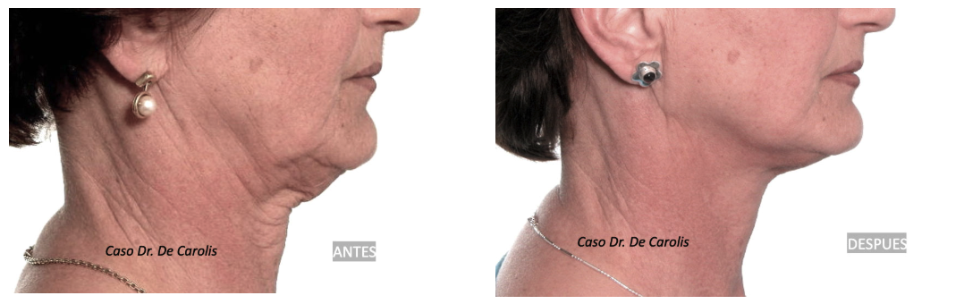Mejora del perfil facial con hilos tensores permanentes por el Dr. Vicente De Carolis