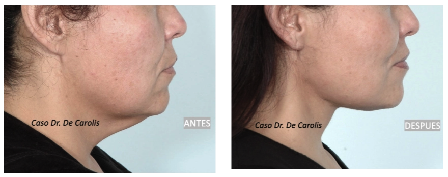 Rejuvenecimiento del cuello con hilos tensores permanentes por el Dr. De Carolis: redefinición total sin cicatrices.