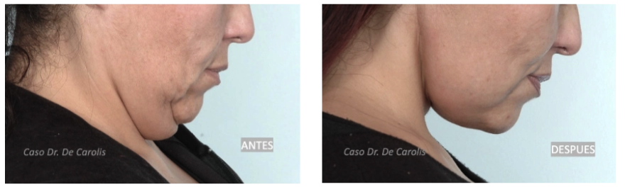 Rejuvenecimiento del cuello con hilos tensores permanentes por el Dr. De Carolis: vista cuello en flexión.