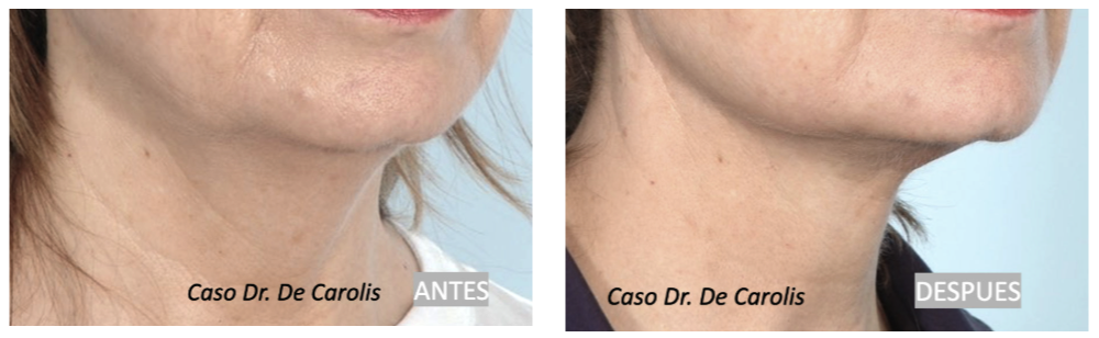 Rejuvenecimiento facial con hilos tensores permanentes por el Dr. De Carolis: contorno redefinido y cuello elevado.