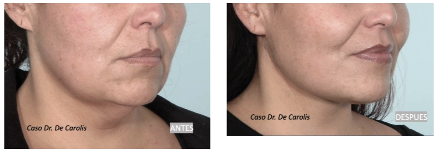 Rejuvenecimiento del cuello por el Dr. De Carolis: vista  semiperfil.